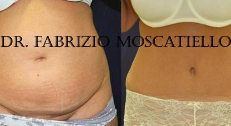 Abdominoplastia Barcelona
