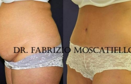 Abdominoplastia Sabadell