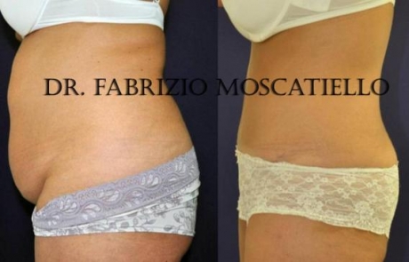 Abdominoplastia fotos antes y despues Barcelona