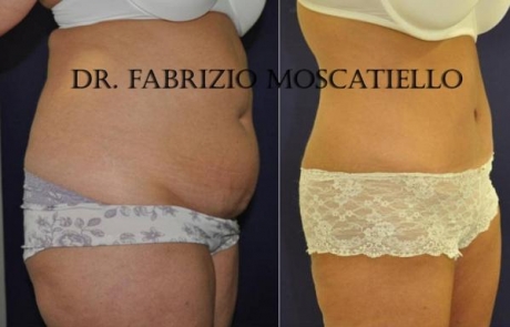 Abdominoplastia fotos antes y despues Sabadell