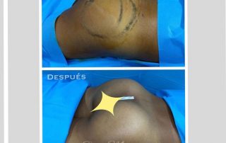 Antes y depues de un aumento de gluteos en Barcelona