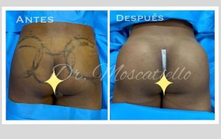 Antes y depues de una cirugia de gluteoplastia en Barcelona