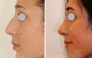 Antes y después de una cirugía de nariz en Barcelona