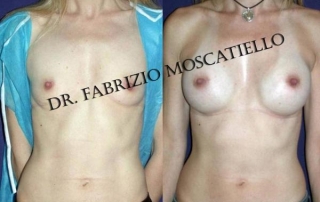 Aumento de senos Sabadell