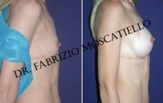 Aumento de senos - Antes y después