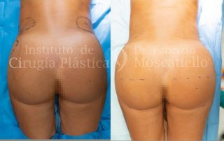 Resultado de una cirugia de aumento de gluteos en Barcelona