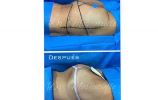Resultado de una cirugia de aumento de nalga en Barcelona