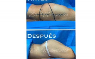 Resultado de una cirugia de aumento de nalgas en Barcelona