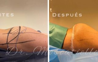 Resultado de una cirugia de gluteoplastia en Barcelona