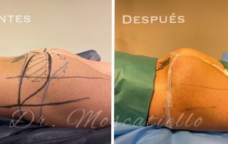 Resultado de una gluteoplastia en Barcelona