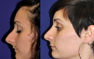 Rinoplastia Barcelona Antes y depués Perfil