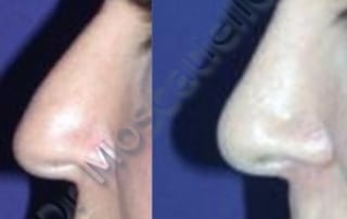 Rinoplastia Sabadell Imagen Antes y depués