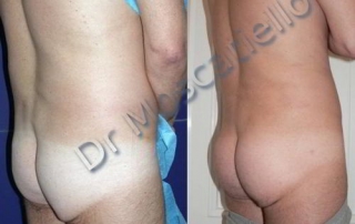 Resultado aumento de glúteos en Barcelona