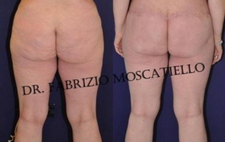 Resultado de un aumento de glúteos en Barcelona