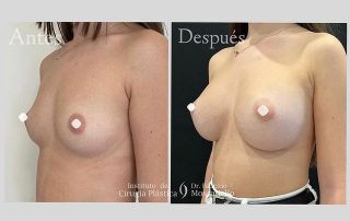 aumento de senos con prótesis en Barcelona antes y después