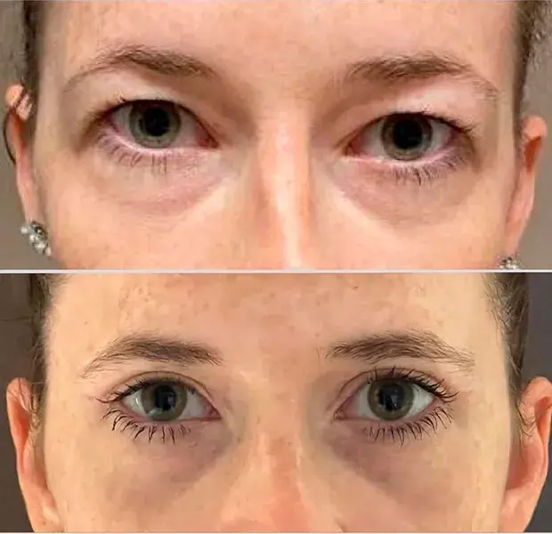 blefaroplastia-barcelona-antes-despues-parpados blefaroplastia-barcelona-antes-despues-parpados