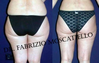 liposucción antes y después en Barcelona