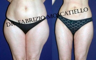 liposucción en Barcelona