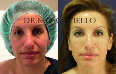 Blefaroplastia Barcelona