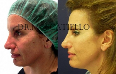 Blefaroplastia superior e inferior en Barcelona