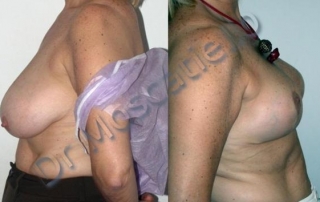 reducción de pecho Barcelona