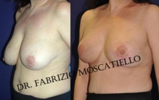 reducción de pecho Sabadell