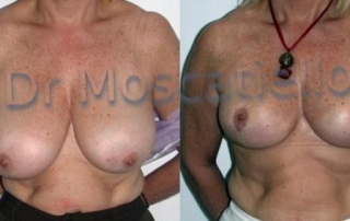 reducción de senos Barcelona