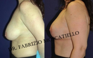 reducción de senos Sabadell