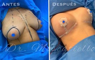 resultado antes y depués de una mamoplastia de reducción en Barcelona Dr Fabrizio Moscatiello