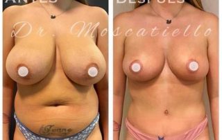 resultado antes y depués de una reducción de pechos en Barcelona Dr Fabrizio Moscatiello