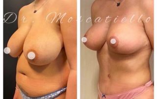 resultado antes y depués de una reducción de senos en Barcelona Dr Fabrizio Moscatiello