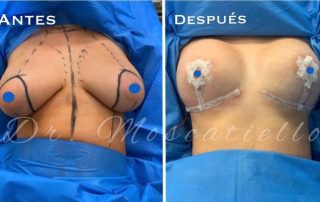resultado antes y depués de una reducción mamaria en Barcelona Dr Fabrizio Moscatiello